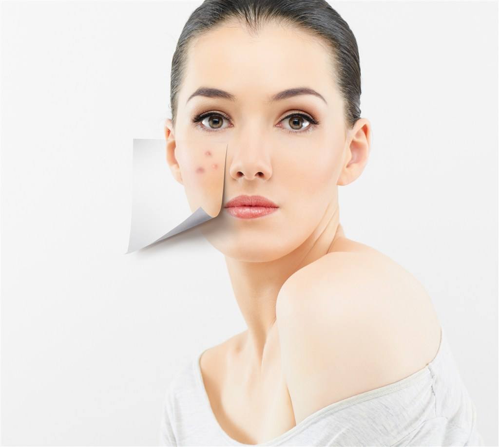 痘印可以用激光去除嗎