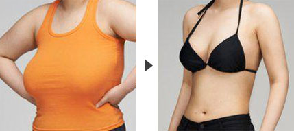 上海乳房縮小整形手術的效果如何