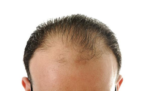 你知道脫發(fā)有哪幾種癥狀嗎?