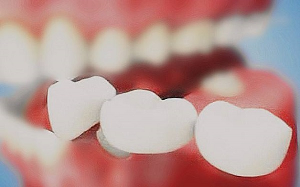 <a href=http://www.f3bb6.cn/listinfo-830-0.html target=_blank class=infotextkey>美容冠</a>多少錢一顆