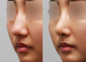 自體注射<a href=http://www.f3bb6.cn/listinfo-737-0.html target=_blank class=infotextkey>隆鼻</a>你效果好嗎