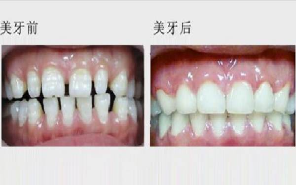 <a href=http://www.f3bb6.cn/listinfo-830-0.html target=_blank class=infotextkey>美容冠</a>前后對(duì)比