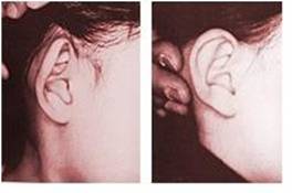 杯狀耳怎么整形