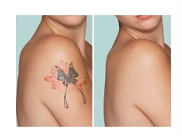 清除紋身要多少錢(qián)