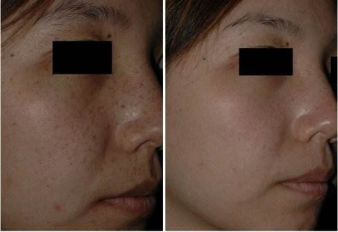 C6激光祛雀斑哪個醫院做的好