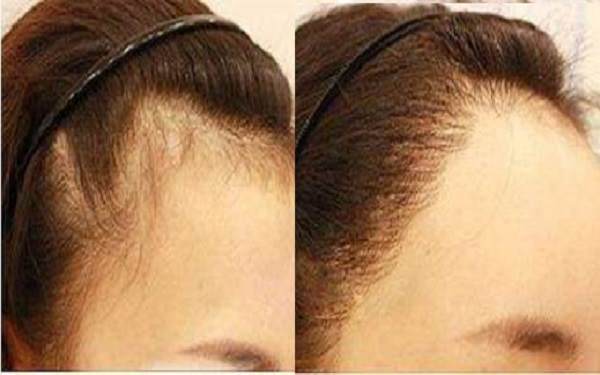 脫發際線前后對照圖
