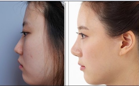 上海膨體<a href=http://www.f3bb6.cn/listinfo-737-0.html target=_blank class=infotextkey>隆鼻</a>手術的優點有哪些