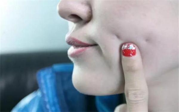 你要知道的酒窩成形后遺癥