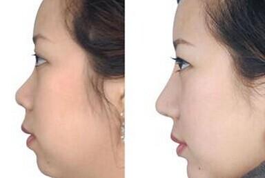 進(jìn)口硅膠<a href=http://www.f3bb6.cn/listinfo-737-0.html target=_blank class=infotextkey>隆鼻</a>是長(zhǎng)期的嗎