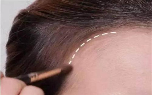 發際線調整多少錢？