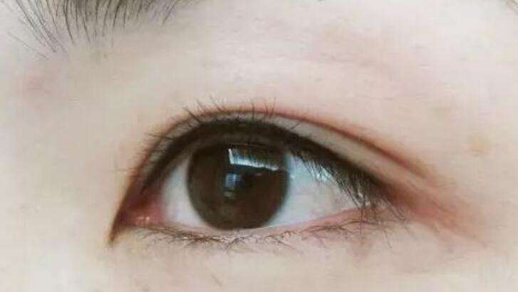 <a href=http://www.f3bb6.cn/listinfo-705-0.html target=_blank class=infotextkey>美瞳線</a>后眼睛腫幾天