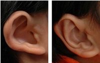 耳廓再造手術費用