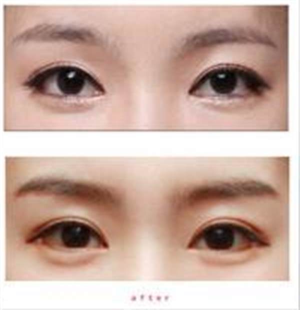 透明質(zhì)酸豐<a href=http://www.f3bb6.cn/listinfo-722-0.html target=_blank class=infotextkey>臥蠶</a>對(duì)會(huì)傷害眼角膜嗎