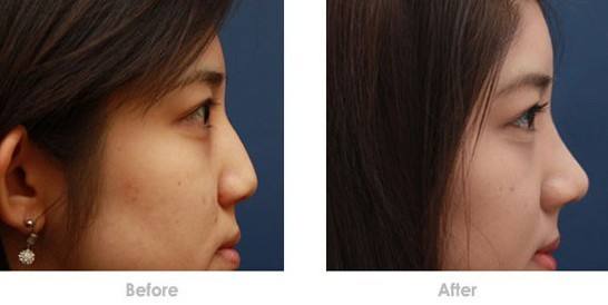 <a href=http://www.f3bb6.cn/listinfo-737-0.html target=_blank class=infotextkey>隆鼻</a>膨體感染的癥狀