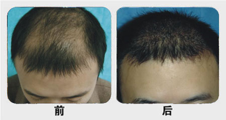 額頭種植毛發多少錢