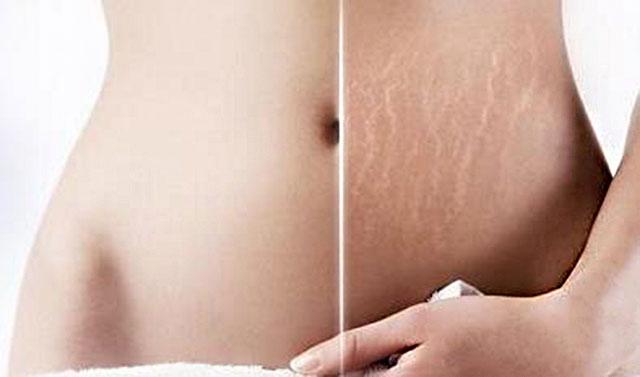 肚子有妊娠紋怎么除去