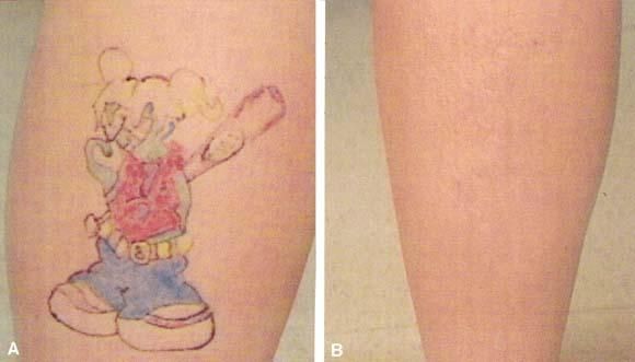 彩色紋身能洗的掉嗎