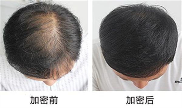 植發價格多少錢