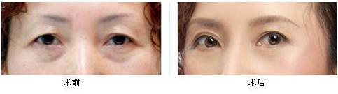 韓式<a href=http://www.f3bb6.cn/listinfo-655-0.html target=_blank class=infotextkey>切眉</a>術(shù)做法有哪些