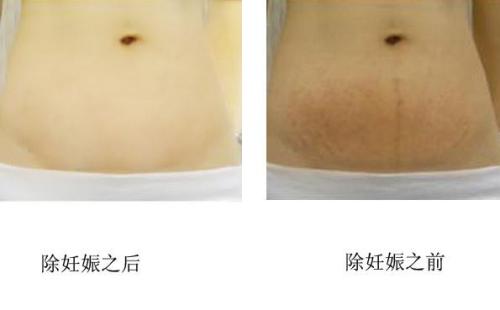 妊娠紋消除要多少錢