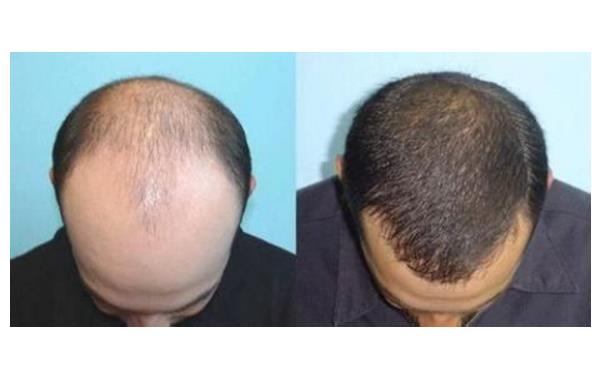 重慶<a href=http://www.f3bb6.cn/listinfo-662-0.html target=_blank class=infotextkey>治療脫發</a>醫院哪個較好