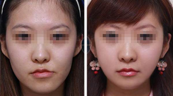 面頰填充術價格