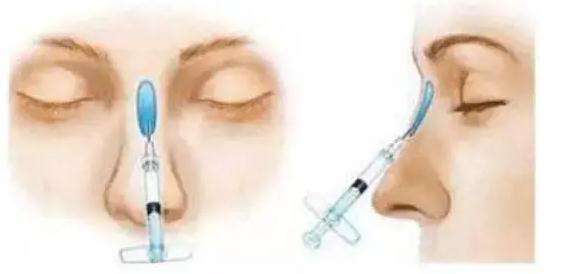 注射<a href=http://www.f3bb6.cn/listinfo-737-0.html target=_blank class=infotextkey>隆鼻</a>有什么副作用