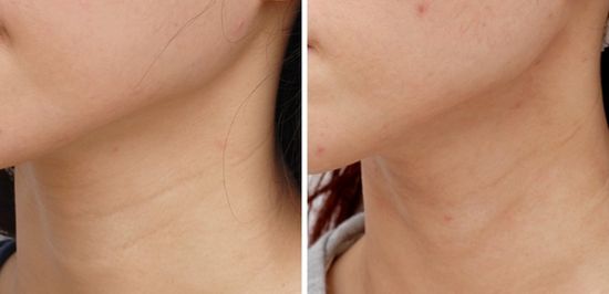 如何<a href=http://www.f3bb6.cn/listinfo-785-0.html target=_blank class=infotextkey>去頸紋</a>