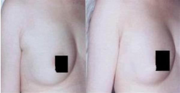 副乳切除術對腋臭有影響嗎