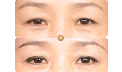 <a href=http://www.f3bb6.cn/listinfo-655-0.html target=_blank class=infotextkey>切眉</a>后飲食禁忌需要注意什么