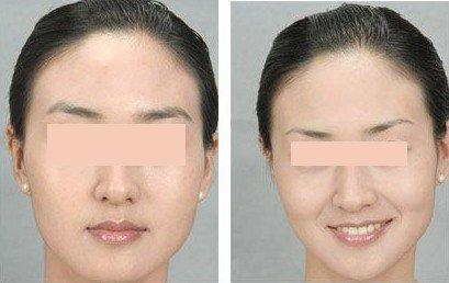 <a href=http://www.f3bb6.cn/listinfo-655-0.html target=_blank class=infotextkey>切眉</a>失敗后遺癥怎么處理