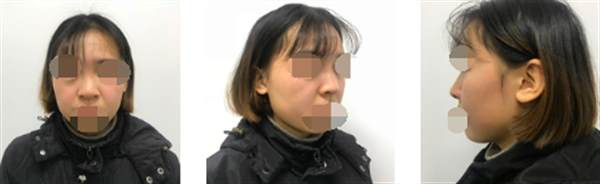 韓式<a href=http://www.f3bb6.cn/listinfo-737-0.html target=_blank class=infotextkey>隆鼻</a>前后對比照片案例