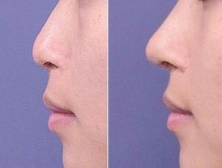 南京韓式<a href=http://www.f3bb6.cn/listinfo-737-0.html target=_blank class=infotextkey>隆鼻</a>哪里好