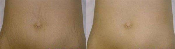 深州<a href=http://www.f3bb6.cn/listinfo-613-0.html target=_blank class=infotextkey>射頻</a>治療腹部妊娠紋好嗎