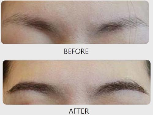 高低眉矯正多少錢