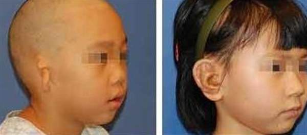 全<a href=http://www.f3bb6.cn/listinfo-699-0.html target=_blank class=infotextkey>耳再造</a>術(shù)的效果怎么樣