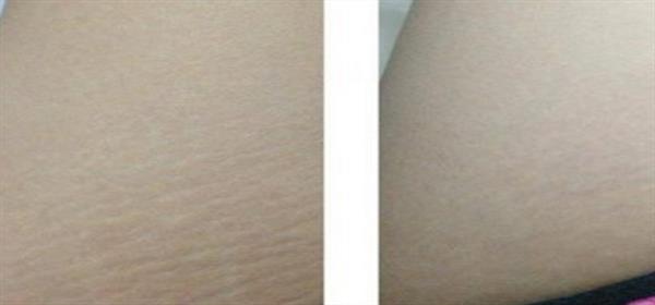 肥胖紋可以完全去掉嗎