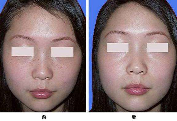 祛黃褐斑多少錢？