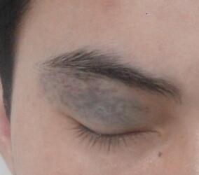 <a href=http://www.f3bb6.cn/listinfo-799-0.html target=_blank class=infotextkey>去太田痣</a>多少錢？