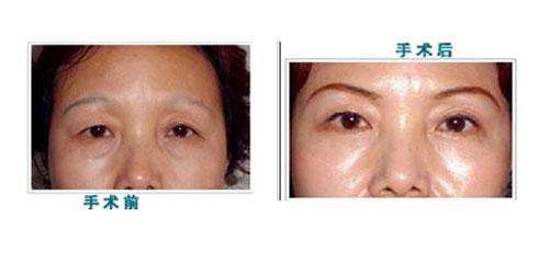 韓式提眉術有哪些優勢?