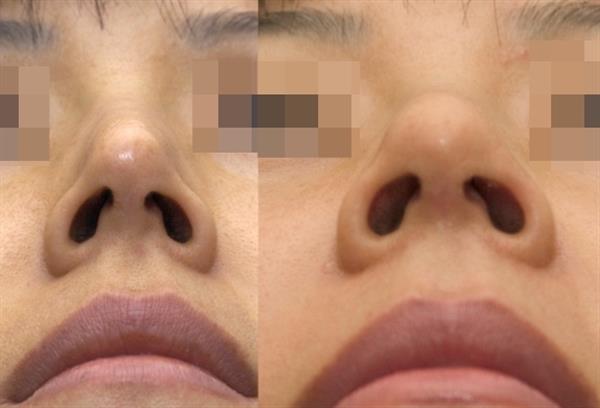 <a href=http://www.f3bb6.cn/listinfo-745-0.html target=_blank class=infotextkey>鼻孔整形</a>的四大適應(yīng)癥