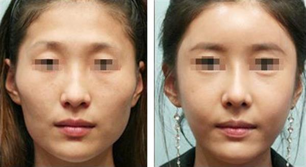 脂肪面部填充危害大嗎