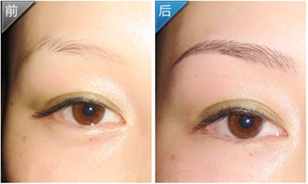 <a href=http://www.f3bb6.cn/listinfo-655-0.html target=_blank class=infotextkey>切眉</a>術(shù)的原理？