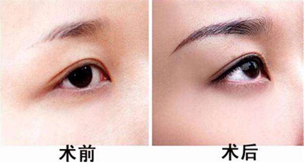 <a href=http://www.f3bb6.cn/listinfo-655-0.html target=_blank class=infotextkey>切眉</a>術與提眉術對比？