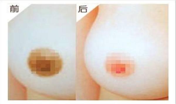 上海<a href=http://www.f3bb6.cn/listinfo-616-0.html target=_blank class=infotextkey>乳暈整形</a>手術真的很快捷嗎