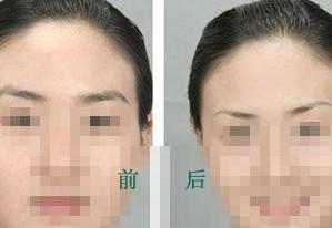 <a href=http://www.f3bb6.cn/listinfo-655-0.html target=_blank class=infotextkey>切眉</a>術的手術過程步驟及術后護理？