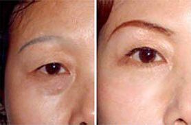 提眉術后疤痕怎樣消除?