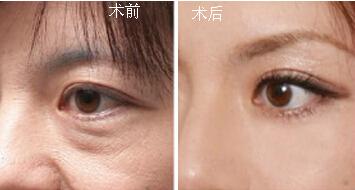 提眉術(shù)的兩種手術(shù)方式？