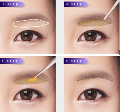 提眉術可以改善眼部哪些問題呢?