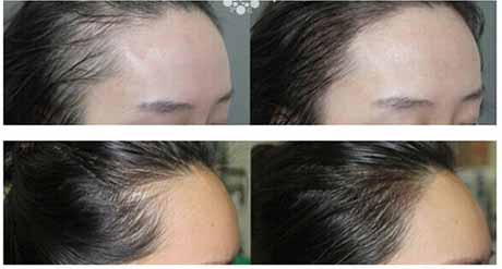 半長期紋發際線多少錢？